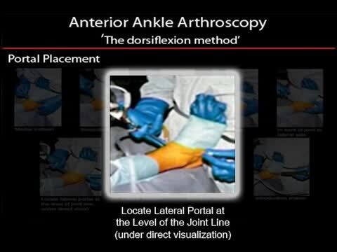 Set Up for Anterior Ankle Arthroscopy: Dorsiflexion Method Positioning, Portals and Diagnostic Examination