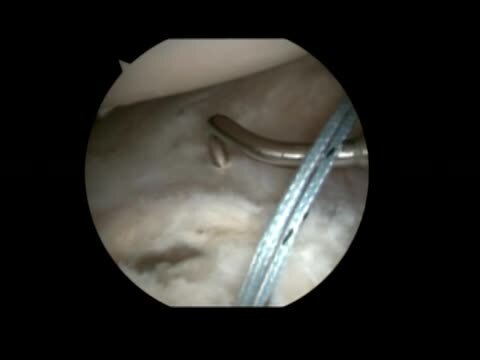 Arthroscopic Surgical Techniques: Arthroscopic Glenohumeral Instability Repair Pearls and Pitfalls