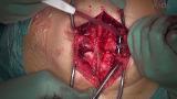 How to Reduce Unbalanced Severe Isthmic Spondylolesthesis