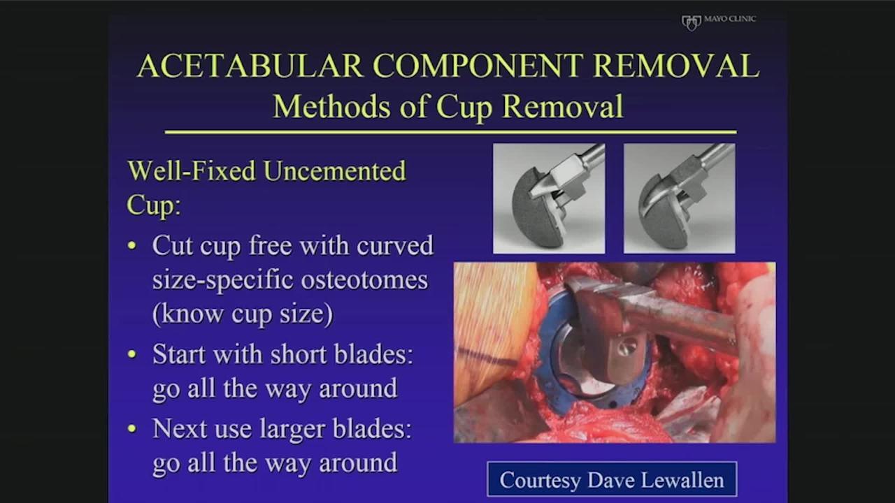 I Can Remove Any Acetabular Component With Minimal Bone Loss