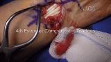 Proximal Row Carpectomy with Resurfacing