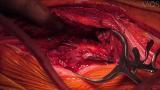 Repair of Distal Femoral Periprosthetic Fracture Nonunion Using a Linked Nail Plate Construct