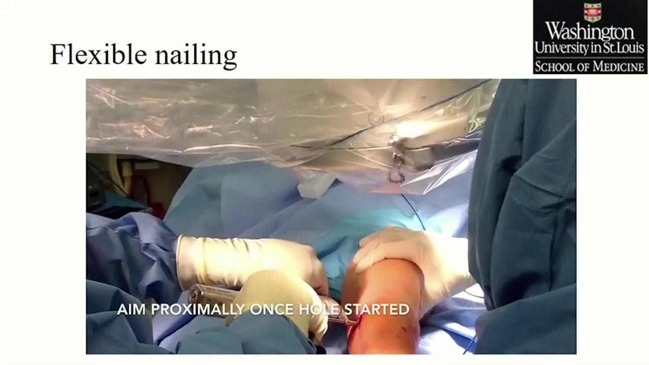 Flexible Nailing of a Femoral Shaft Fracture