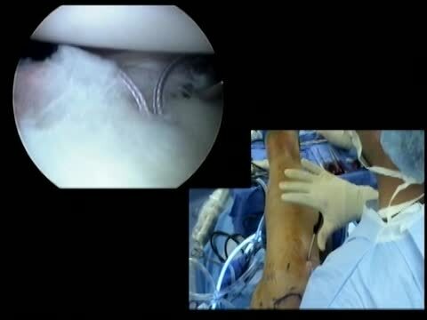 Arthroscopic Surgical Techniques: Arthroscopic Anterior Instability Repair
