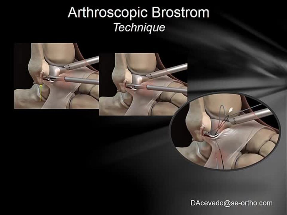Arthroscopic Techniques for Repair: Ankle Lateral Ligaments - Jorge I. Acevedo