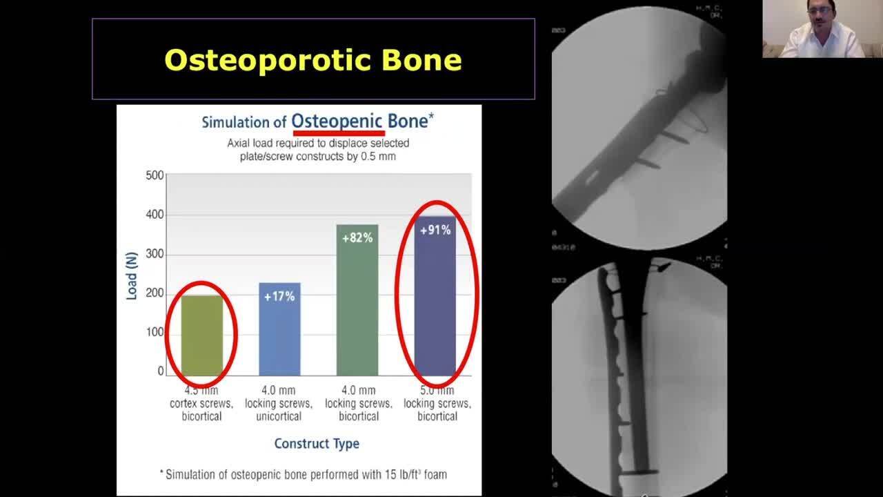 Periprosthetic Fractures and New Concepts of Osteoporotic Fixation