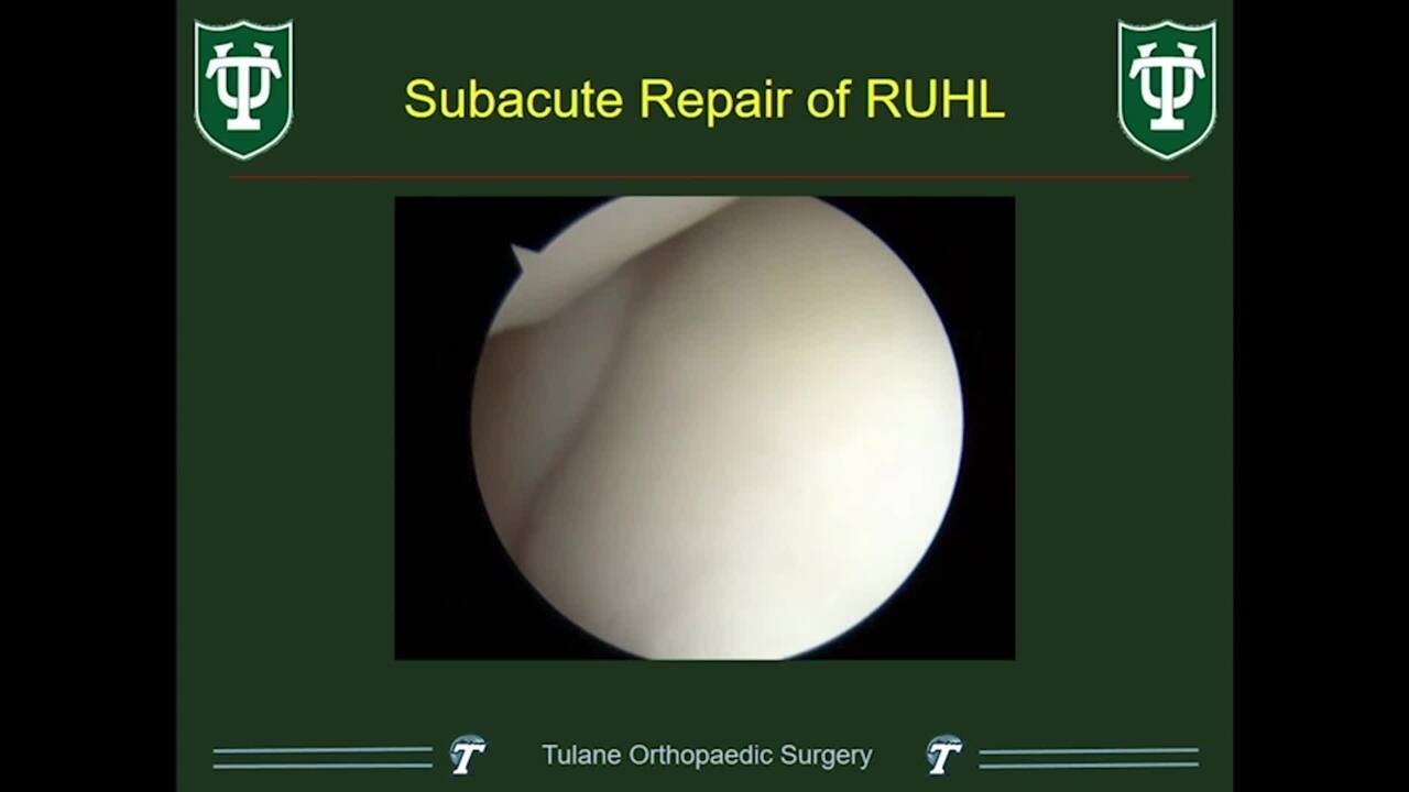 Arthroscopic and open repair for traumatic lateral instability of the elbow