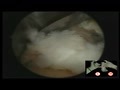 Arthroscopic Surgical Techniquest: Advanced Ankle Arthroscopy - Posterior Ankle Arthroscopy
