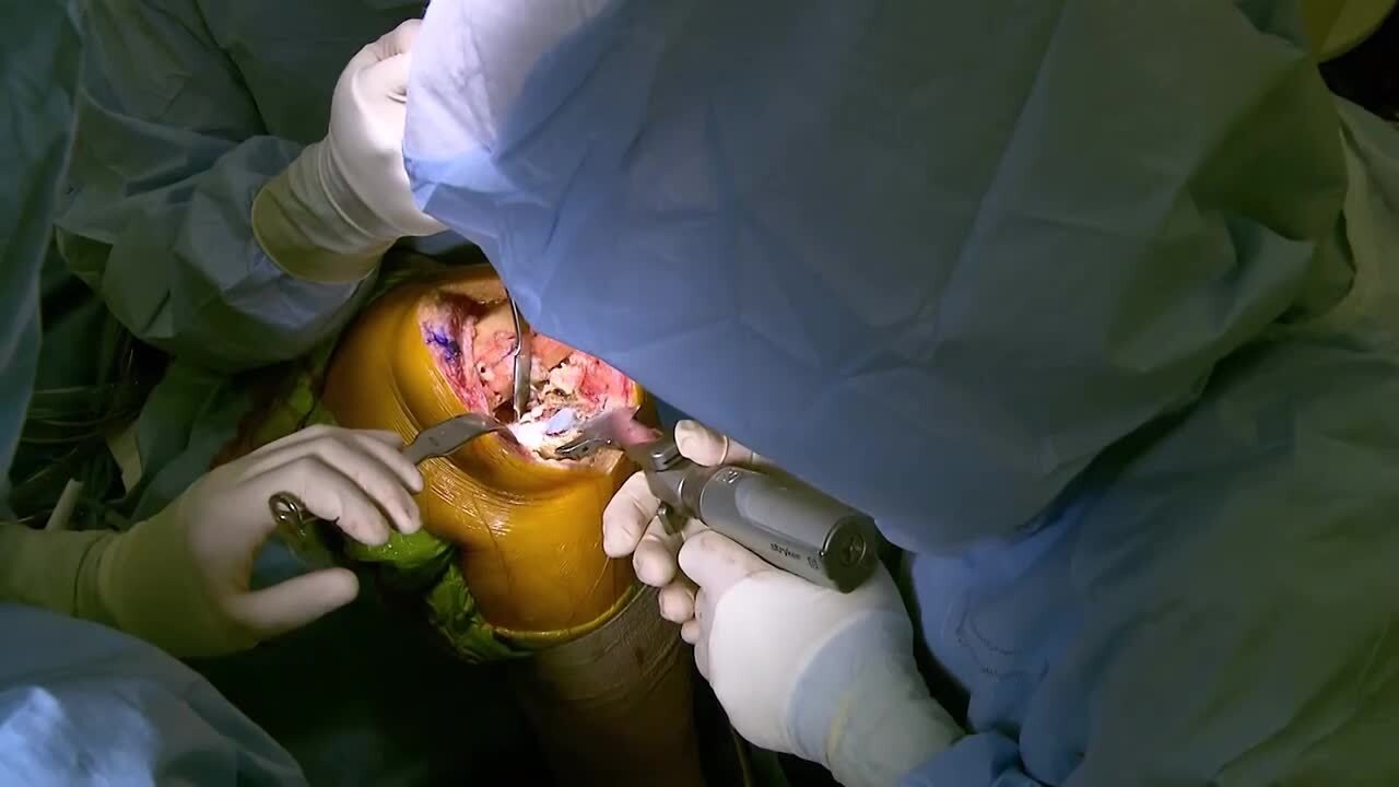 Sacrectomy Video Video Details