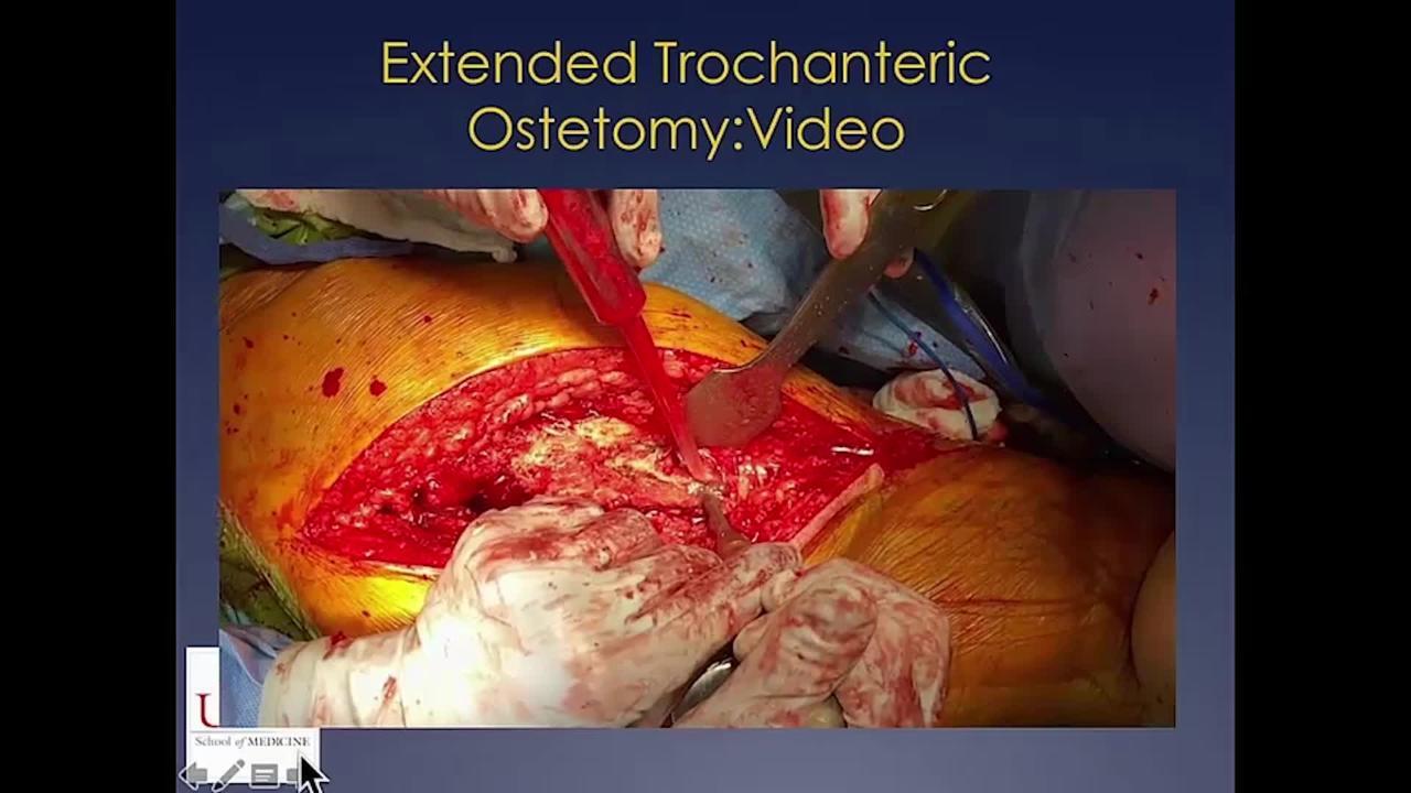 When and How to: Osteotomies of the Proximal Femur to Revise Total Hip Stems