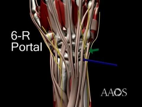 Wrist Arthroscopy Basic Anatomy and Portal Placement: Animation