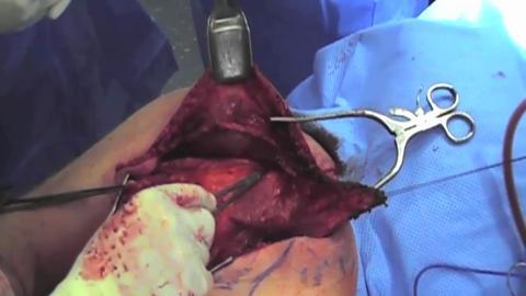 Resection of Axillary Sarcoma