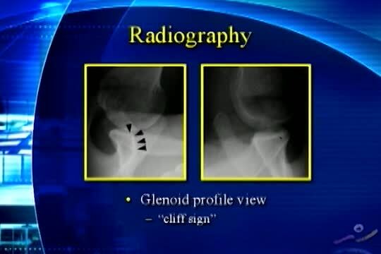 Arthroscopic Surgical Techniques: Anterior Glenohumeral Instability: Imaging Studies in Anterior Glenohumeral Instability