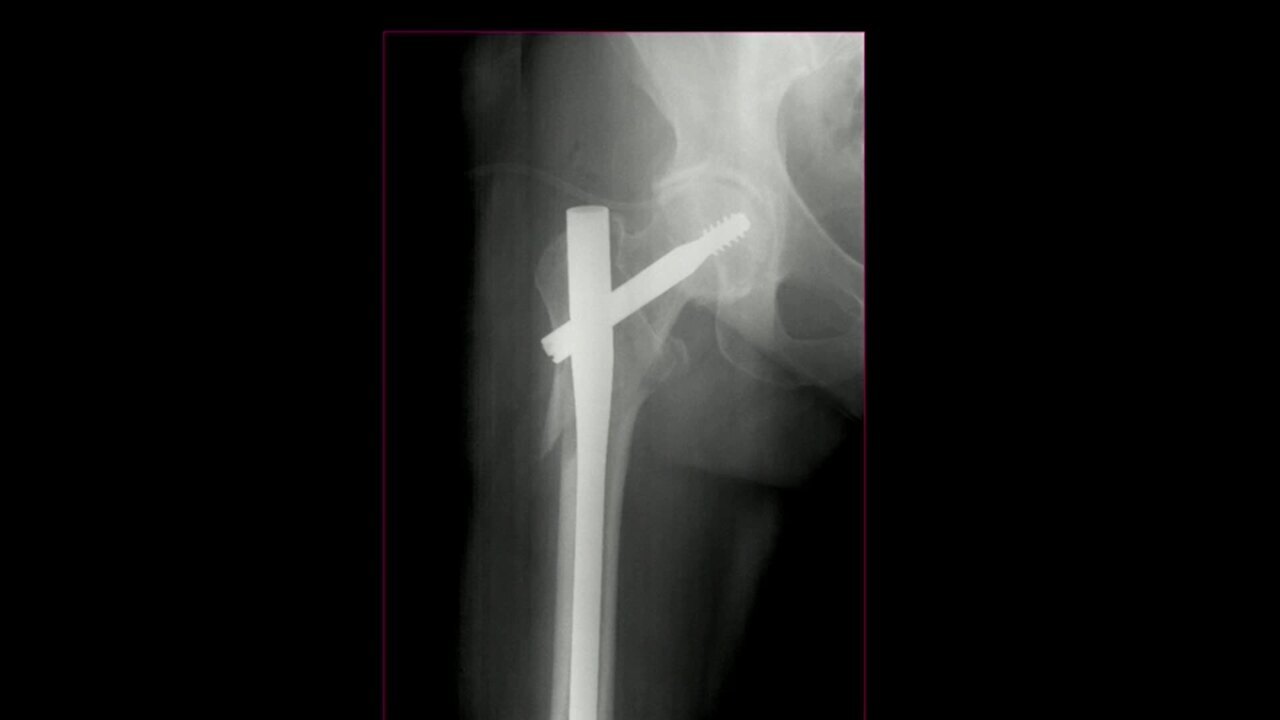 When and How to Use Arthroplasty in Acute and Failed Hip Fracture Treatment: The Latest Surgical Techniques