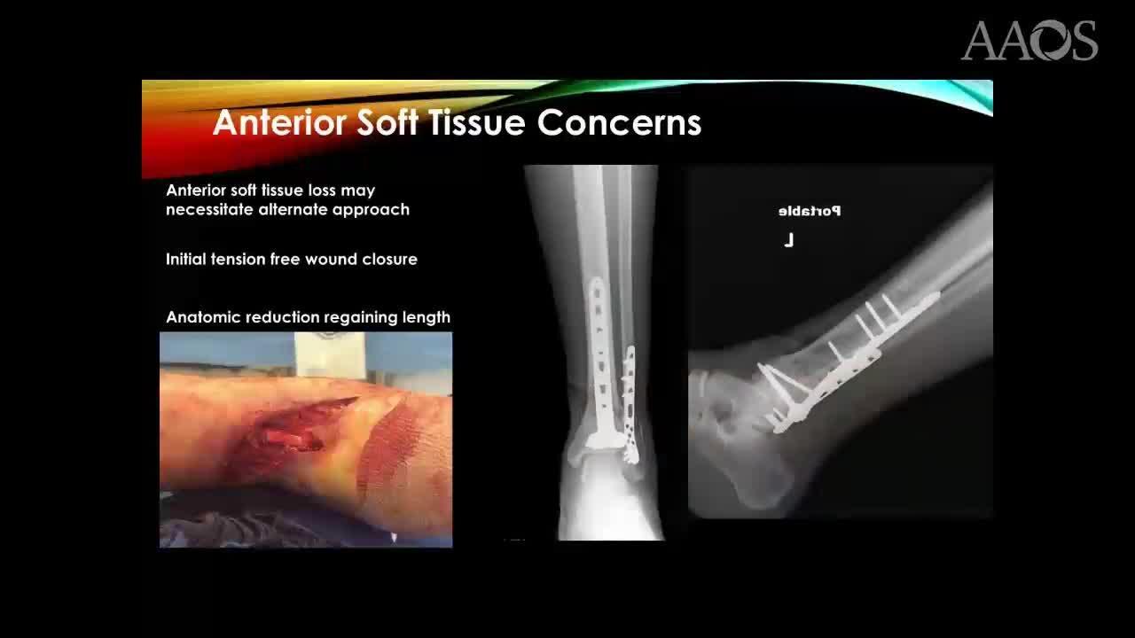 Posterior Ankle Approach Strategies (for Fracture Fixation)