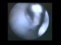Set Up for Anterior Ankle Arthroscopy: Dorsiflexion Method Positioning, Portals and Diagnostic Examination
