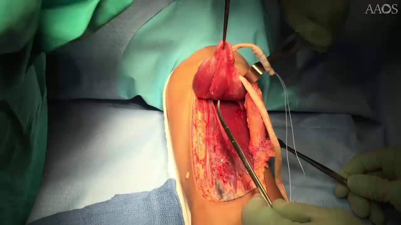 Distal Biceps Tendon Reconstruction with Tibialis Allograft for Chronic Tears
