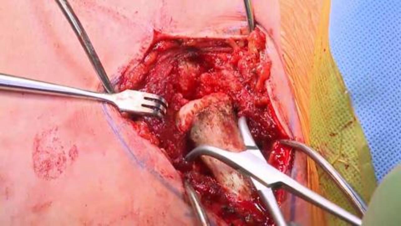 Autograft Reconstruction of Sternoclavicular (SC) Joint Instability