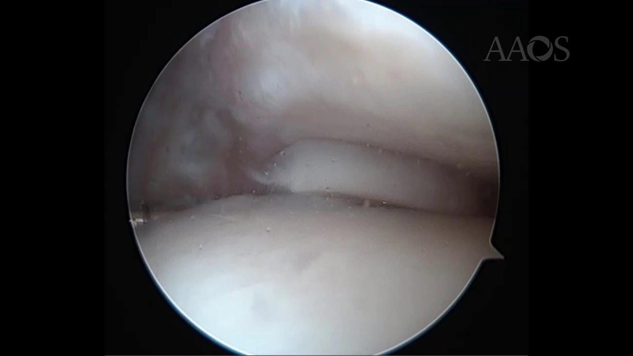 Osteochondral Lesions of the Talus Managed via Particulated Juvenile Articular Cartilage