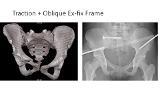 Posterior Pelvic Ring Injuries: Open and Percutaneous Reduction and Fixation