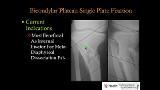 Fixation Options for Bicondylar Tibial Plateau Fractures
