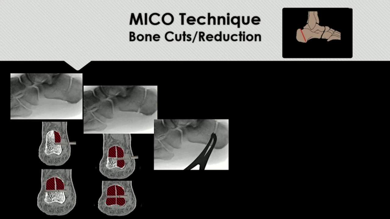 Minimally Invasive Surgery (MIS) Techniques for Lesser Toe Deformities