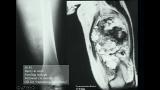 Common Soft-Tissue Tumors