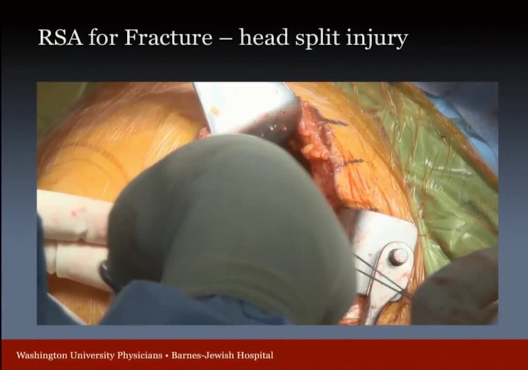 Reverse Shoulder Arthroplasty: Proximal Humerus Fractures