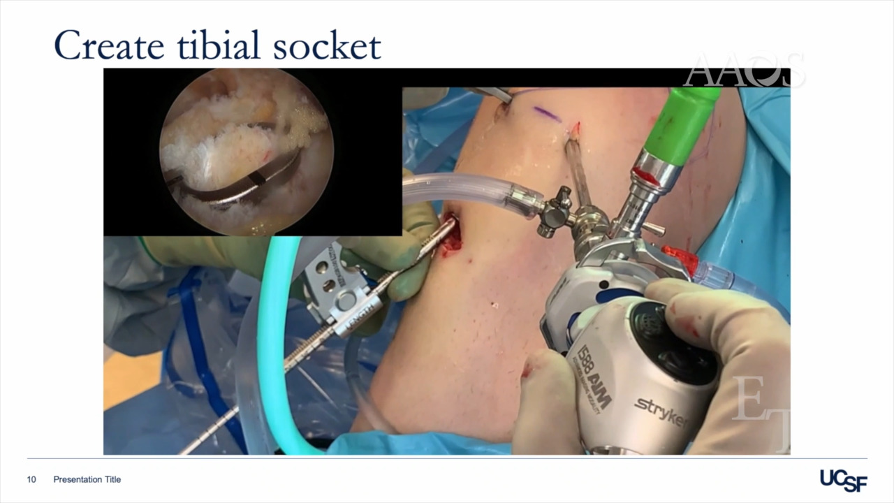 AAOS OVT - All-inside ACL Reconstruction