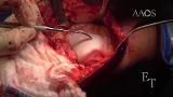 Bony and Soft-Tissue Surgery for Refractory Patellofemoral Instability