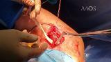 Pectoralis Major Tendon Transfer With Tibialis Anterior Allograft for Management of Medial Scapular Winging
