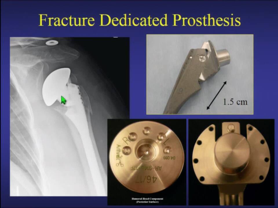 Where Does Arthroplasty Fit in Fracture Care?