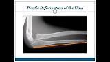 Pediatric Monteggia Fractures
