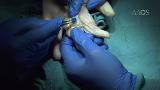 Proximal Interphalangeal Joint Silicone Arthroplasty: Volar Approach