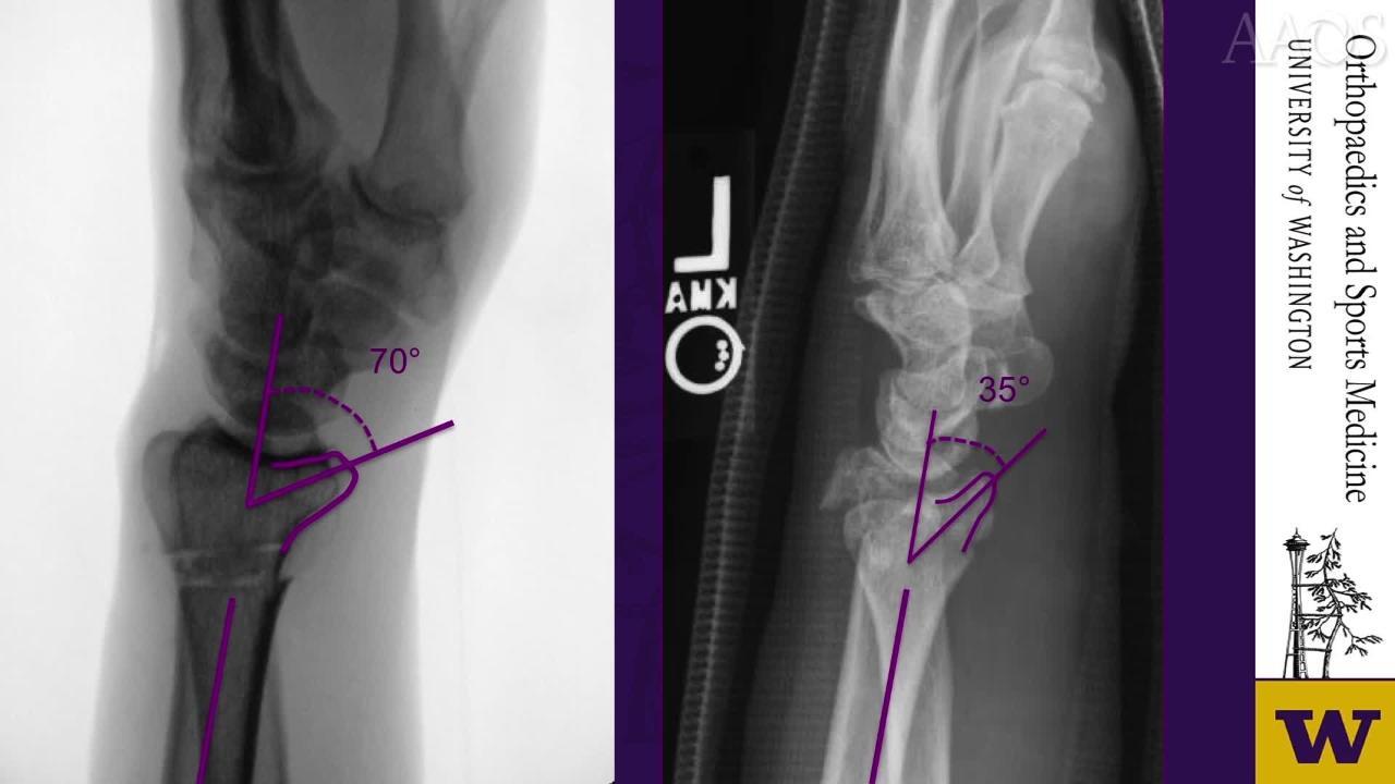 Distal Radius Fractures: Radiographic Anatomy and Manual Reduction Techniques