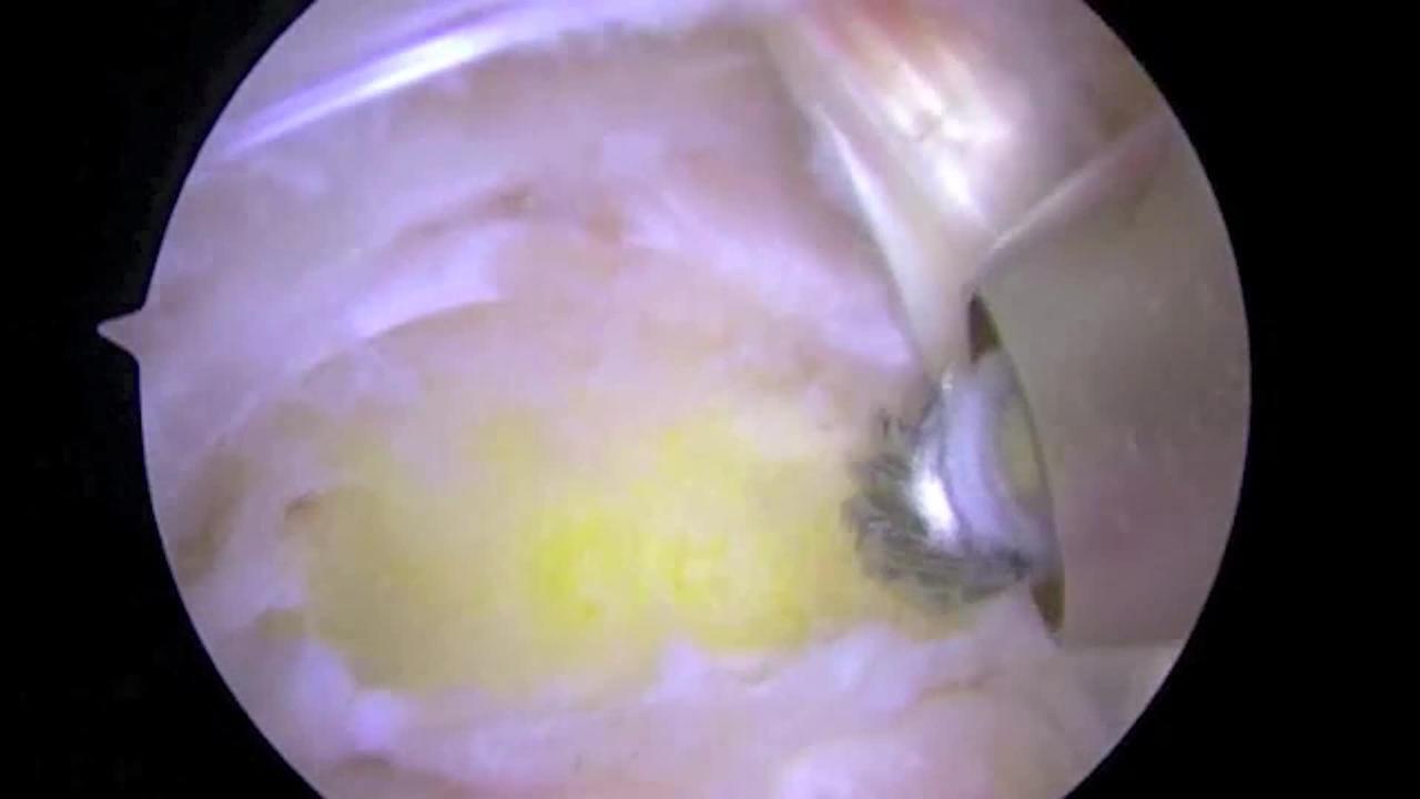Posterior Ankle Arthroscopy Resection