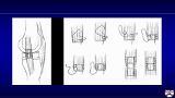 Intraoperative Complications