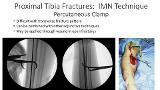 Very Proximal Tibia Fractures