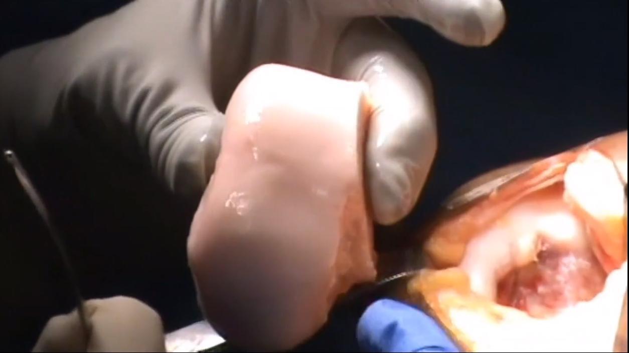 Fresh Osteochondral Allograft for Management of Osteochondral Defects of the Knee