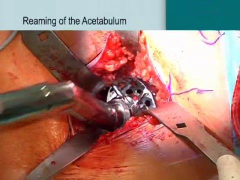Single Incision Direct Anterior Approach to Total Hip Arthroplasty
