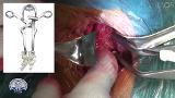Anterior Cervical Discectomy and Fusion for Myelo-Radiculopathy
