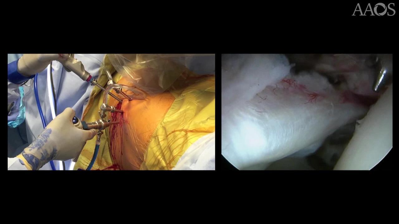 Use of Bone Marrow Aspirate Concentrate with Hip Labral Repair for the Management of Chondrolabral Junction Breakdown