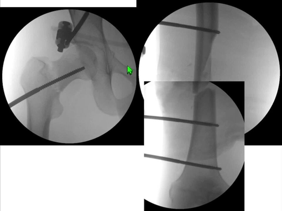 Fixation of Intracapsular Hip Fractures: When and How