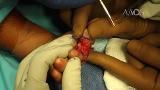 Bilateral Acrosyndactyly From Constriction Ring Syndrome