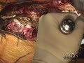 Posterior Approach To The Thoracic Spine