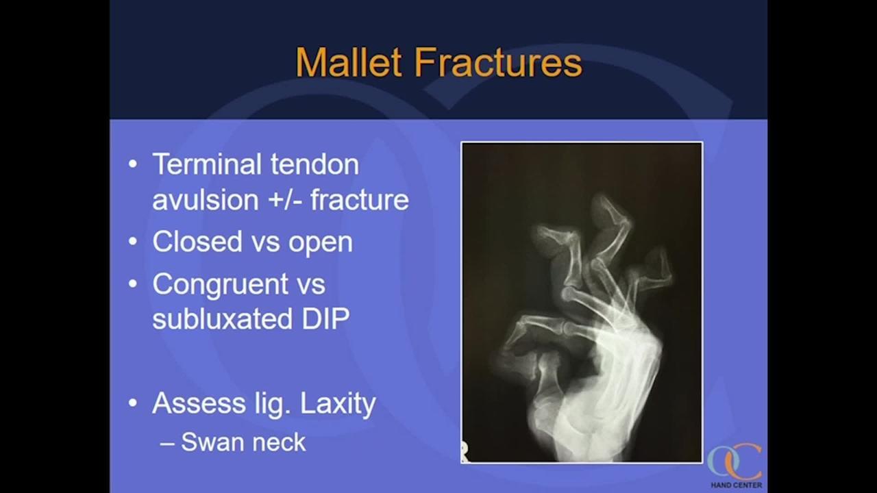 Mallet Fractures and Fingertip Injuries