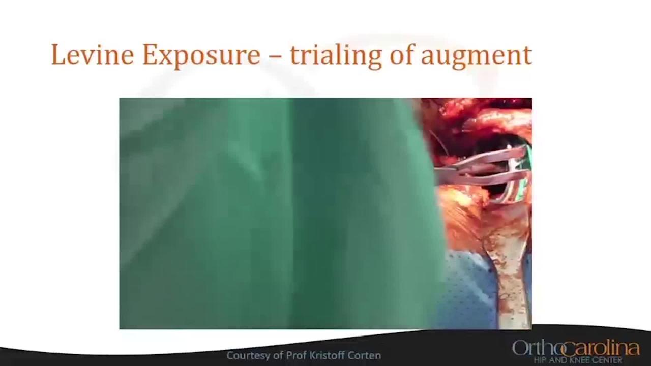 Extending the Direct Anterior Approach for Complex Cases: Acetabular and Pelvic Exposure