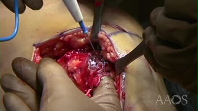 Medial Approach for MCL Reconstruction or Repair in Multi-ligament Knee Injury