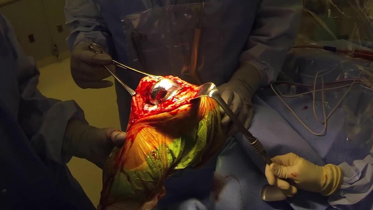 Intraoperative Evaluation of Knee Stability