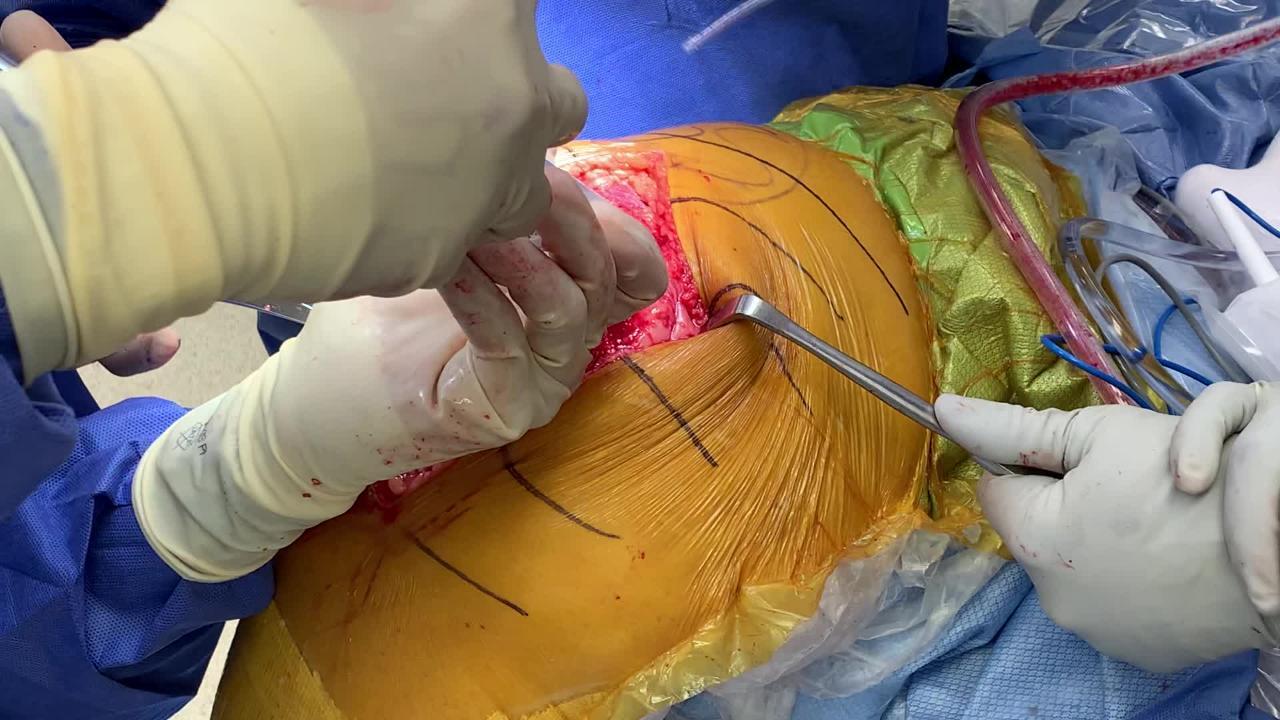 Total Knee Replacement Periarticular Injection Video